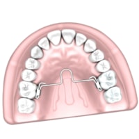 Barra Palatina Ortodôntica com Loop Mesial - Morelli