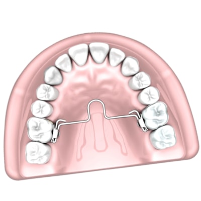 Barra Palatina Ortodôntica com Loop Mesial - Morelli