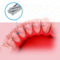 Contenção TwistForm 3x3 - Ø0,50mm - Morelli