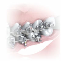 Elástico Intraoral de Silicone 5/16 Médio (6008113) - Morelli