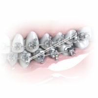 Elástico Intraoral de Silicone 5/16 Médio (6008113) - Morelli