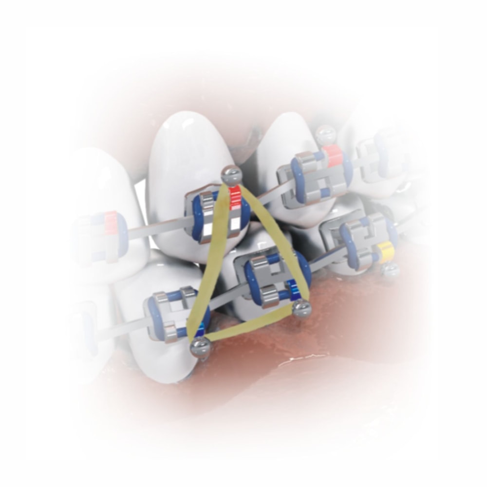 Elástico Intraoral Látex 3/16 Morelli Apoio Dental