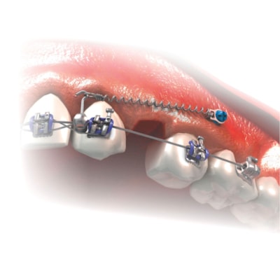 Miniparafuso Ortodôntico Cabeça de Bráquete Anti-horário (Compr.: 6mm - Transm.: 1mm - Ø1.5mm) - Mor