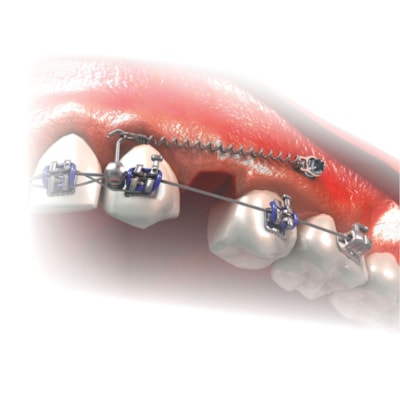 Miniparafuso Ortodôntico Cabeça de Bráquete Horário (Compr.: 6mm - Transm.: 1mm - Ø1.5mm) - Morelli